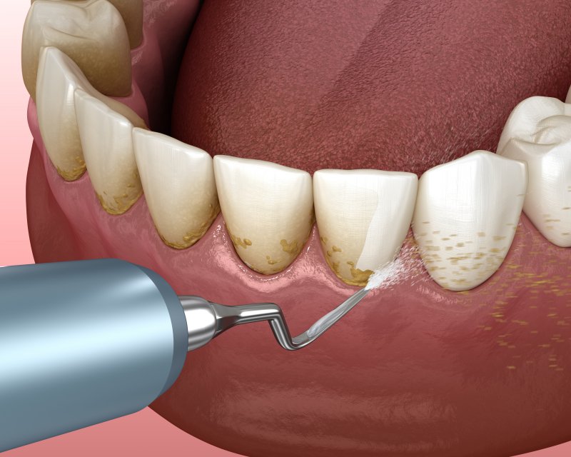 an image of plaque being removed from a person’s teeth