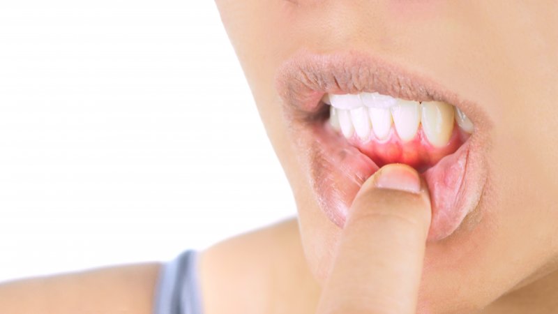 a person pulling their lip down to expose their red gums