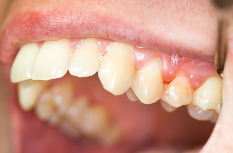 a person exposing their top row of teeth to show an area of the gums that are bleeding