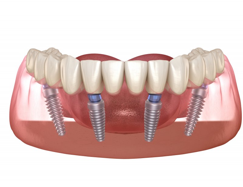 a digital image of a bottom row of teeth secured to All-On-4 dental implants