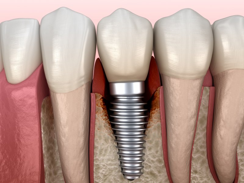 a digital image of a bottom row of natural teeth with a dental implant replacement