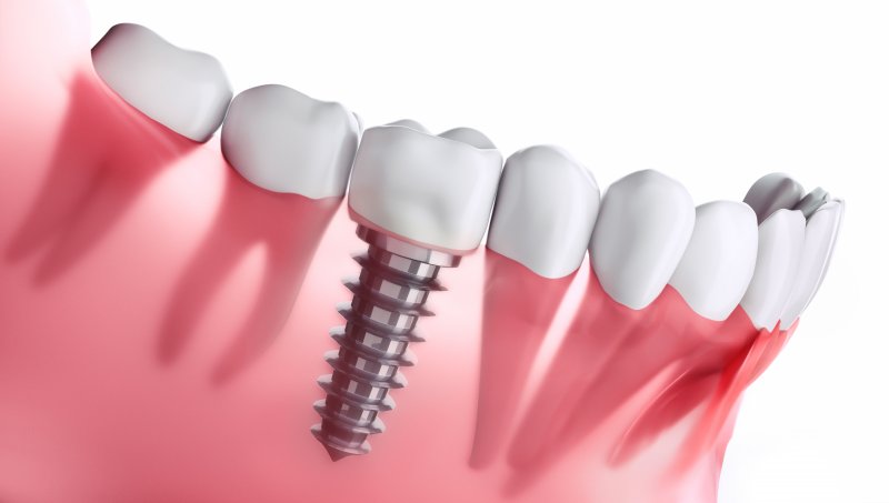 a digital image of a single tooth dental implant situated next to healthy teeth along the bottom arch