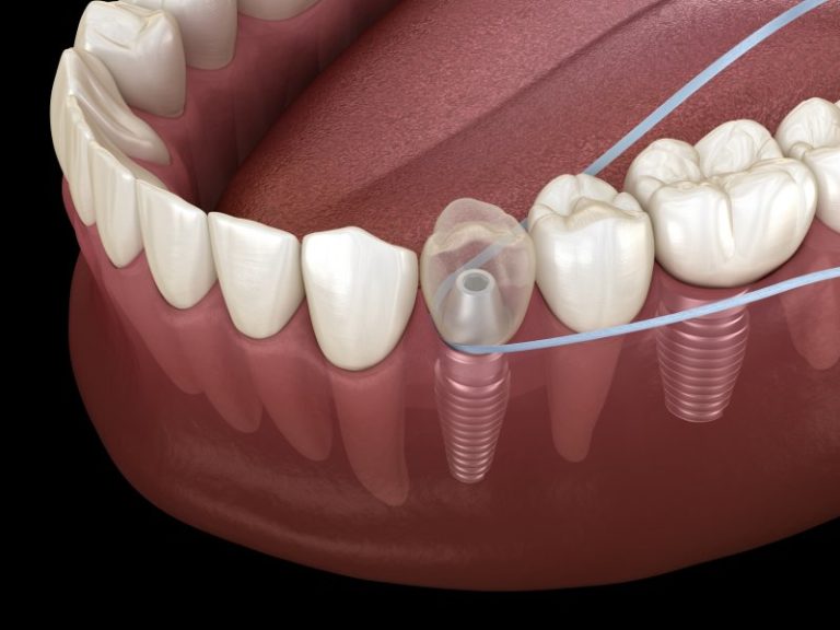 Flossing Dental Implants Technique Jacksonville Dental Specialists