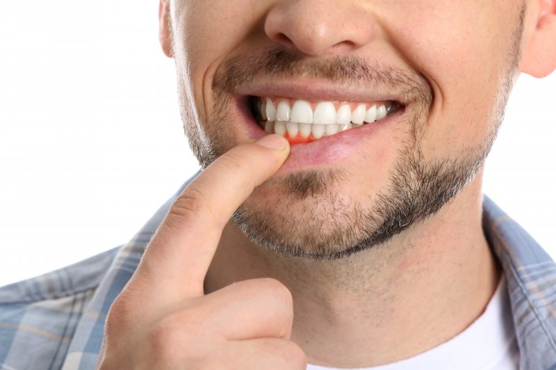 An up-close view of a man exposing his lower gums that appear red 