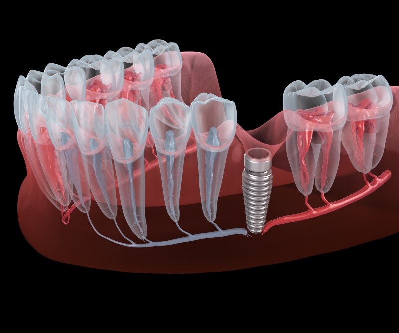 A digital image of a failed dental implant and the nerve breaking