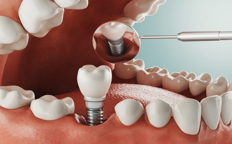 a digital image of a single tooth dental implant sitting in the lower arch of the mouth