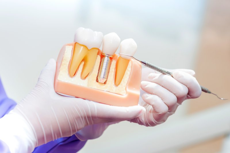 a dental professional pointing to a cross-section of a mouth mold that contains a single tooth dental implant