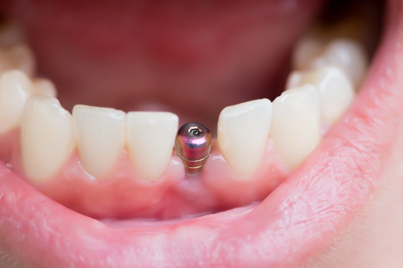an up-close image of a dental implant sitting between two healthy teeth on the lower arch