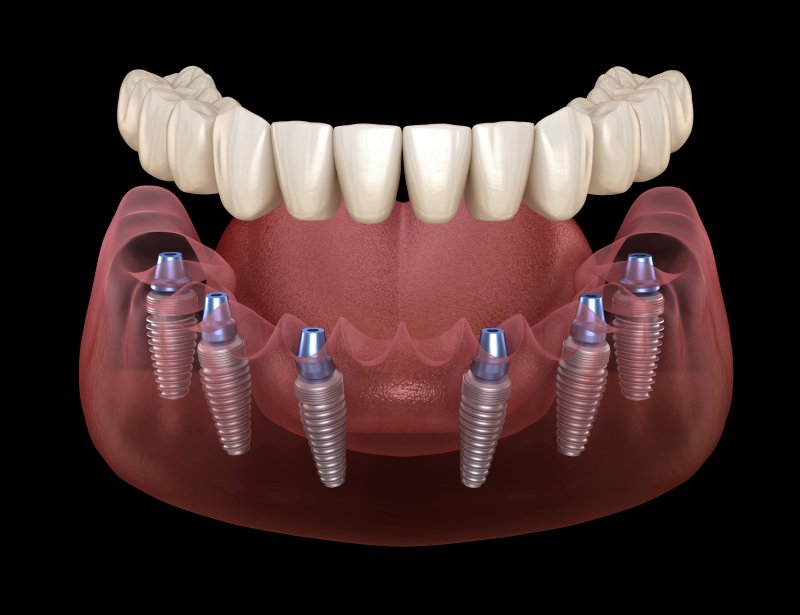 implant dentures in Jacksonville