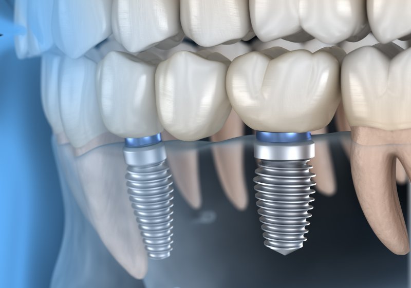 a dental implant bridge