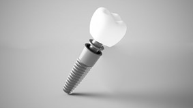 a single dental implant