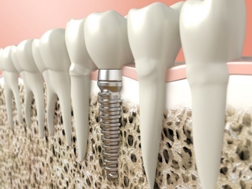 a single dental implant