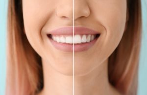 a before and after picture of someone who had gum recontouring