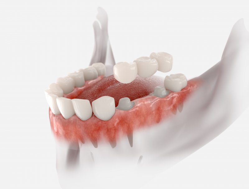 a 3D illustration of a dental bridge