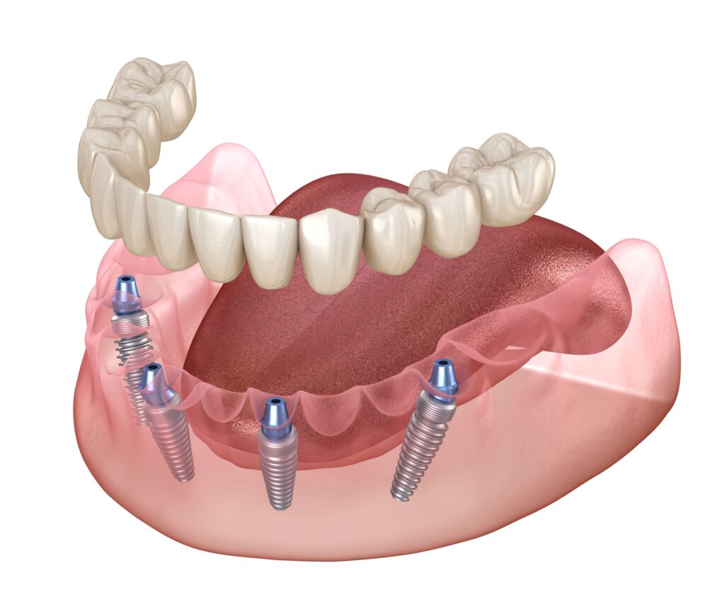 Illustration of lower arch of dentures attached to 4 dental implants