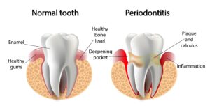 Illustration of normal tooth vs. one affected by gum disease.